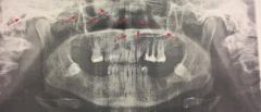#9 
appears as a "J" or "U" shaped radiopacity located superior to the maxillary first molar region; articulates with the zygoma (cheekbone)