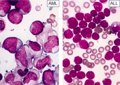 - AML: moderately abundant, granules often present
- ALL: scant to moderate, granules lacking