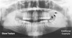 radiopaque bulge distal to third molar region; rounded prominence of bone