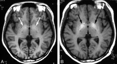 copper
aut rec

dystonia
tremors
basal ganglia problems
kayser-fleischer -- + neuropsych symp

MRI = dilated ventricles with atrophy of cerebrum and lesions in thalamus and basal ganglia

decreased ceruloplasmin

tx = penicillamine with chelation...