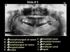 indistinct radiopacity anterior to the mandibular foramen; small, tongue-shaped projection of bone