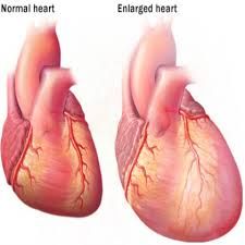 cardiomegaly