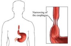 narrowing of the esophagus 
-due to incomplete recanalization following an epithelial proliferation phase