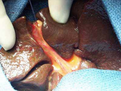 -hepatic or bile duct fails to recanalize following phase of epithelial proliferation