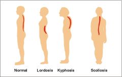 1. Abnormal lordosis
- Protruding lumbar (gut)
2. Kyphosis
- Increased thoracic curvature (hunched)
3. Scoliosis
- Lateral deviation of spine from midline
