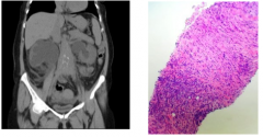 Can sclerosing retroperitoneal fibrosis cause ureteral obstruction? What type of inflammatory disorder is this? What does it encase? What age does this occur? Is an obvious cause often identified? What are some drugs, one disease, and malignancies...