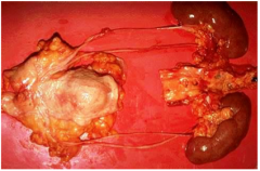 Congenital anomalies of the ureters are found in what percent of all autopsies? 
 
What are double ureters usually accompanied by?