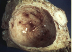 What is shown here? 


 


What are the dark brown patches in the mucosa due to? 


 


What is the pathway from obstruction => crypts and kidney damage? 