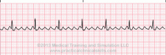 Rhythm:  Regular
Rate: 60-100
P Wave:  Cannot identify
PRI: Not measureable
QRS: 0.06-0.10
QRS:  Narrow
Identifiable by:  Sawtooth
