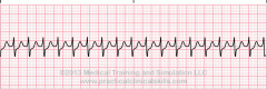 Rhythm:  Absolutely Regular
Rate: >150
P Wave:  Cannot identify
PRI: Not measureable
QRS: 0.04-0.10
QRS:  Narrow

