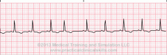 Rhythm:  Regular
Rate: <100
P Wave:  shorter & spiked or humped; early and upright
PRI: 0.12-0.20
QRS: 0.04-0.10
QRS:  Narrow  
