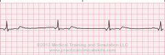 Rhythm:  Regular 
Rate: 40-60
P Wave:  Inverted before or after QRS <0.12
Characteristics:  J shaped

