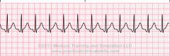 Rhythm:  Regular 
Rate: 101-200
P Wave:  Inverted before or after QRS <0.12
Characteristics:  J shaped
