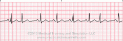 Rhythm:  Irregular
Rate: <100
P Wave:  Inverted before or after QRS <0.12
Characteristics:  J shaped

