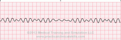 Rhythm:  Regularity chaotic undulating
Rate:
P Wave: 
QRS:  Wide
Charceristics:  looks like a childs scribbles

