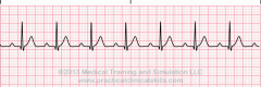 Rhythm:  Regular
Rate:  60-100, depends on underlying rhythm
P Wave:  Normal in size and shape; 
PRI:  Prolonged (i.e., more than 0.20 sec)
QRS:  0.11 or less
Charceristics:  
