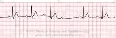 Rhythm:  Ventricular irregular; atrial regular 
Rate:   Atrial > than ventricle
P Wave:  Normal in size and shape; Some P's not followed by QRS
PRI:  Inconsistant;  The PRI after a nonconducted P wave is shorter than the interval preceding the non...