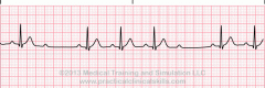 Rhythm:  Ventricular irregular; atrial regular
Rate:   Atrial > than ventricle, ventricular is slow
P Wave:  Normal in size and shape; Some P's not followed by QRS
PRI:  Within normal limits or prolonged but constant for the conducted beats; the P...