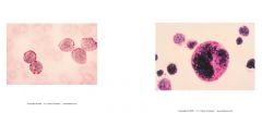 -stains glycoproteins and glycogen in many cell types
-ALL exhibits "Block staining" in lymphoblasts (left)
-erythroblasts in erythroleukemia usually exhibits intense granular pattern (right)