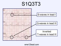 1-acute onset pleuritic pain and dyspnea, tachypnea 
tachycardia 
2-S1Q3T3 large S wave in lead I, a Q wave in lead III, and an inverted T wave in lead III indicates acute right heart strain. and is termed the "McGinn-White sign" after the initi...