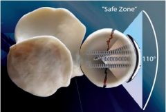 62-1 Elbow Arthroscopy which portal not used, why
2-MC:condition to cause nerve injury w/ elbow scope?   MC nerve injured w/ scope? MC portal to cause sinus tract?
3-MC direction of elbow dislocation? longest period of immobilization or conseque...