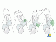 1 posterior medial->injury to ulnar nerve
2-MC condition- RA & joint contracture & stiffness 
MC nerve inj-ulnar Nerve
MC portal sinus- poster lateral 
3-Pos-lat
-3 immobilization>3 wks-->joint contracture & stiffness 
4-anconeus, brachialis...
