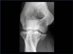 A 34-year-old male falls from a roof and sustains a right elbow dislocation that is closed reduced in the emergency room. An AP radiograph is shown in Figure A. This injury pattern is at highest risk for which of the following? 
1.  Anterior inte...