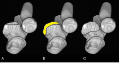 Anteromedial coronoid facet fracture and LCL injury following an elbow dislocation is commonly associated with varus posteromedial rotatory instability. Varus and posteromedial rotation force on the forearm results in rupture of the LCL from its h...