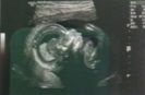 This image shows clear distinction between the gray scale of various structures in the fetal brain. The ability to distinguish similar structures with varying gray scale is termed:
a. axial resolution
b. contrast resolution
c. lateral resolutio...