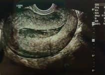 What type of transducer was used to create this image of the uterus?
a. linear array
b. phased array
c. single elemtn mechanical
d. tightly curved array
e. sector