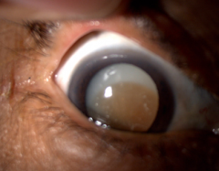 Type of cataract?  Complication?