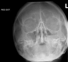 What is/are the major error(s) in this image of the facial bones? The patient has a blowout fracture.