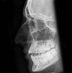 What is/are the major errors in the lateral facial bones image?