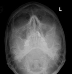 What is/are the major errors on this image of the facial bones? This patient has a tripod fracture.