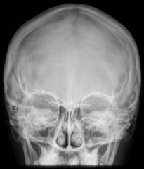What is/are the repeatable errors in this Caldwell skull image?