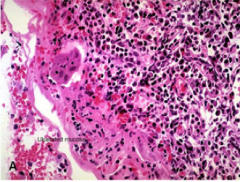 What is this? How is it most common in? 


 


How will the patient present? 


 


What does the histology show? In what layers of the bladder wall? What ulcers MAY be present in some patients? What is the suspected etiology? 