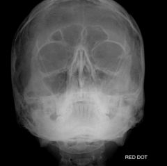 What is/are the major error(s) on this image done for facial bones? The patient has a tripod fracture.