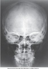 Refer to the image below used to evaluate the cranium. How was the central ray directed to obtain this image?