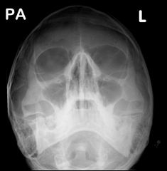 What are the repeatable errors on this image for facial bones?
