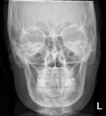 What are the repeatable errors on this Caldwell for facial bones?