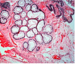 What is this? 


 


Chronic cystitis can cause nests of _________ (Brunn nests) to grow downward into the ________, where they may undergo glandular ________ (termed cystitis glandularis) or retract to produce cystic spaces lined by flattened _...