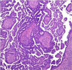 The image depicts a representative section of a cystic right ovarian mass obtained from a 67-year-old woman.  What feature is most likely to be associated with a worse clinical outcome?
