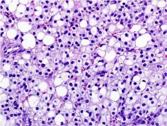 The photomicrograph is representative of a uterine mass removed from a 55-year-old woman who presented with post-menopausal bleeding.  Immunohistochemistry reveals that the tumor cells are + for SMA & HMB45 while negative for S100, desmin, and CK7...