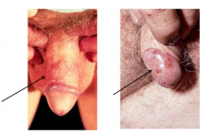 What is shown here? 


 


On the penile skin (as on skin anywhere) is called _____ disease; this is demonstrated in the left panel.  ______ carcinoma in situ on the glans is called ______ of Queyrat.  80% of these lesions are ____ related (us...