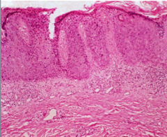 What features does squamous carcinoma of penis share with in situ carcinomas anywhere?