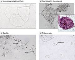 presence of clue cells (w/ coccobaccilli- B)