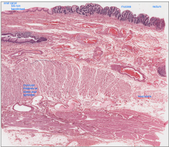 simple squamous non-keratinised epithelium. Muscularis mucosa is thickened of the internal anal sphincter.

this is contrasted to the rectum where  there is a thinner muscularis mucosa and a mucosal gland area.