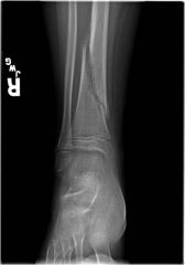 A fracture in which at least one part of the bone has been twisted.