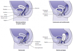Uterine prolapse (grades i-iv)
Cystocele
Rectocele
Enterocele
Urinary incontinence