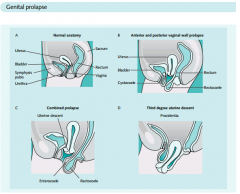 Postmenopausal woman
Posterior vaginal wall protrussion
Digitally assisted removal of stool
Diagnosis --> pelvic exam
